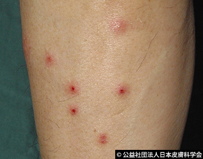 トコジラミの刺し跡